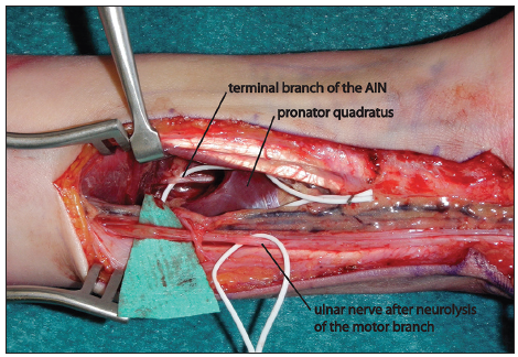 Tendon Transfer